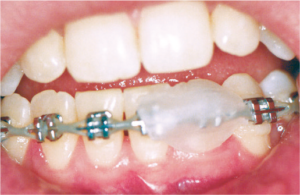 What to do when a braces wire irritates your mouth | Henderson NC Orthodontist