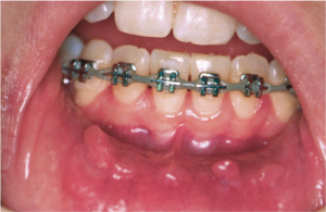 What to do when you get mouth sores with braces | Schmitt Orthodontics