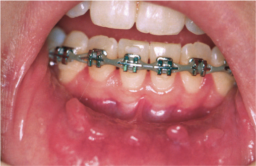 what-to-do-when-you-get-mouth-sores-with-braces-schmitt-orthodontics