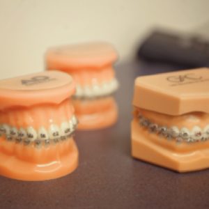How to Choose the Right Type of Braces