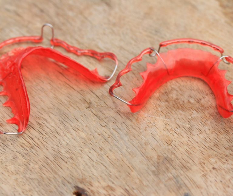 What are the Different Types of Retainers? Schmitt Orthodontics