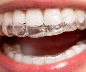 Invisalign vs. Traditional Braces - What's the Right Choice for You