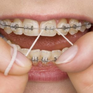 How to Have Great Oral Hygiene with Braces