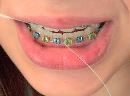 The Do's and Don'ts of Braces