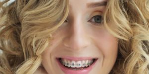 When to Start Orthodontic Treatment