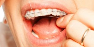 Tips for Spring Cleaning Your Braces